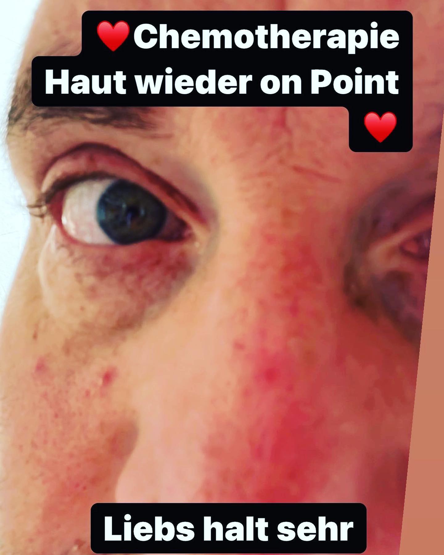 Pizza Fungi …. Aktentaschenakne, oder liebevoll Freddy Krügers Vadder… auch interessant Hügelmann, Kätpn Rotbacke oder Picky Don Pickerlich …Los Picklos fällt euch noch was ein ?

😂😂🙅‍♂️ die besten 10 bekommen keinen Preis 🥇 

#krebsblogger #krebsisteinarschloch #krebskämpfer #krebskrank #cancer #cancerfighter #lifestyle #lifeisgood #lifeisbeautiful #lifecoaching #lifegoals #lifeofadventure #love #selfie #healthylifestyle #healthy #gesundheit #gesundleben #krank #krankheit #lebensfreude #lebengenießen #lebensqualität #lebedeinleben #lebensmotto #fickdichkrebs #zitate