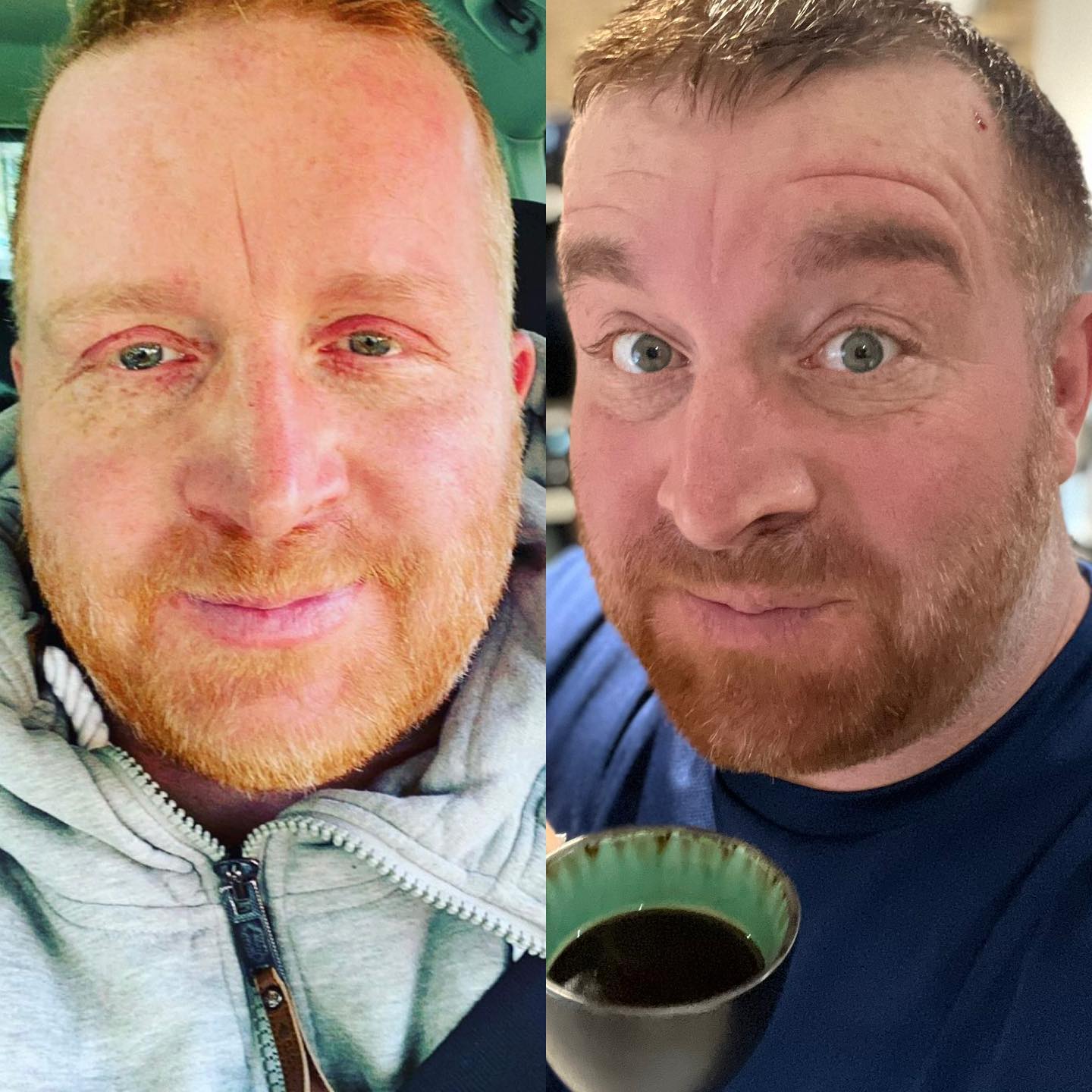 Das Gesicht hinter der Hochdosis Chemotherapie. Unfassbar wie kaputt ich ausgesehen habe und was ich bisher durchmachen musste. 

Eyyyy … Kolbe…. Ich bin sehr sehr stolz auf DICH 🥰😘

Das Bild ist von Februar 2022
und das andere von gestern. 

#krebsisteinarschloch#darmkrebs#krebskämpfer #krebskrank #cancer #cancerfighter #lifestyle #lifeisgood #lifeisbeautiful #lifecoaching #paliativ #darmkrebs#lifeofadventure #love #selfie #healthylifestyle #healthy #gesundheit #gesundleben #krank #krankheit #lebensfreude #lebengenießen #lebensqualität #lebedeinleben #lebensmotto #fickdichkrebs #zitate